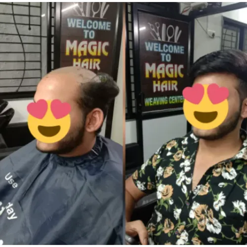 Hair loss affects people for different r