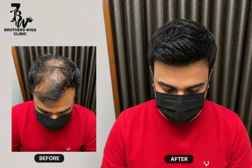 Hair Wig Clinic in Delhi