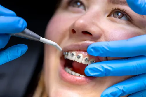 Ceramic Teeth Braces Treatment
