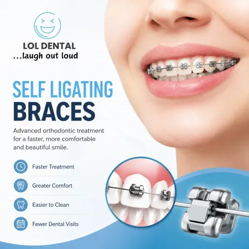 Self Ligating Braces in Jaipur