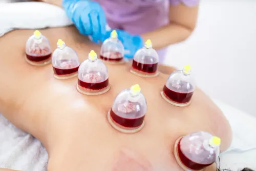 Hijama, also known as wet cupp