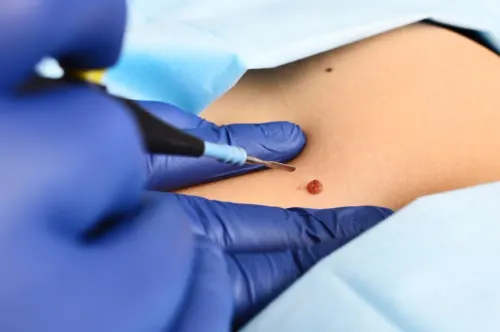 Skin tags 