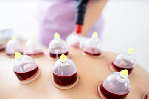 Wet cupping, often referred to