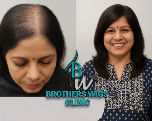 Permanent hair patch for women