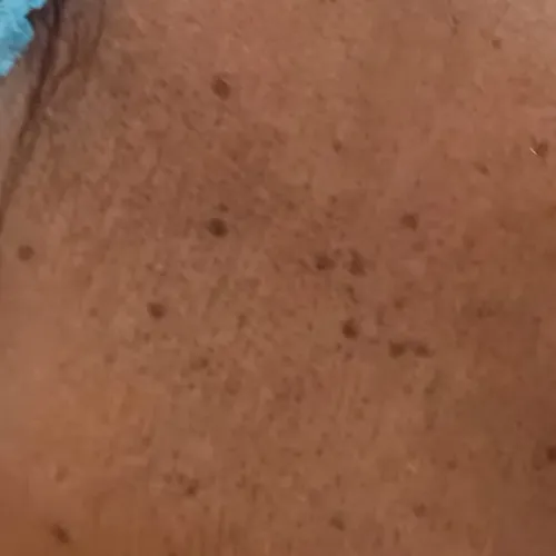 Dr.s.Valarmathi, a dermatologi