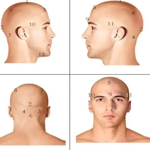 Cupping on the head (also called head Hi