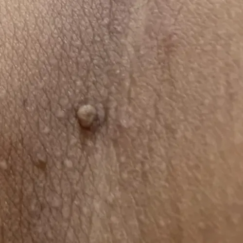 Dr.s.Valarmathi, a skin tag re