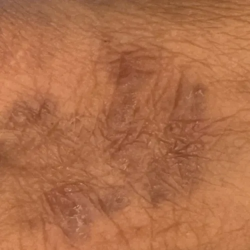 Dr.s.Valarmathi, a skin doctor