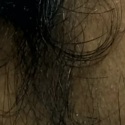 Dr.s.Valarmathi, a skin doctor