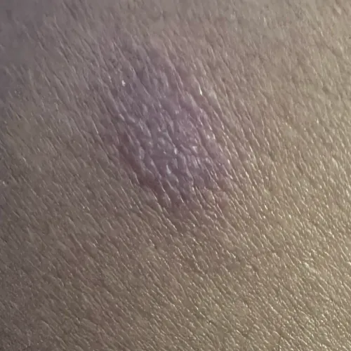 Dr.s.Valarmathi, a skin doctor