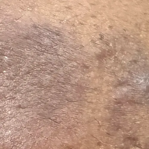 Dr.s.Valarmathi, a skin doctor
