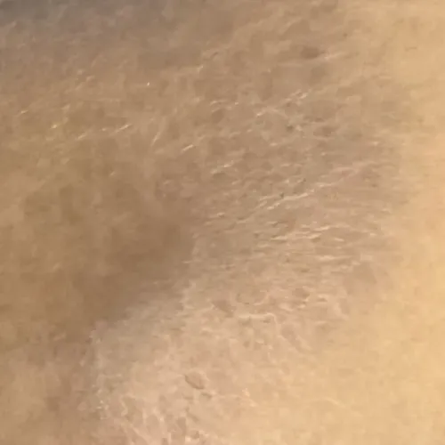 Dr.s.Valarmathi , a skin docto