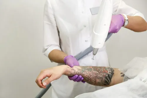 laser tattoo removal sessions