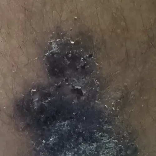 Dr.s.Valarmathi, a skin doctor