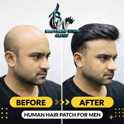 hair thinning around the crown