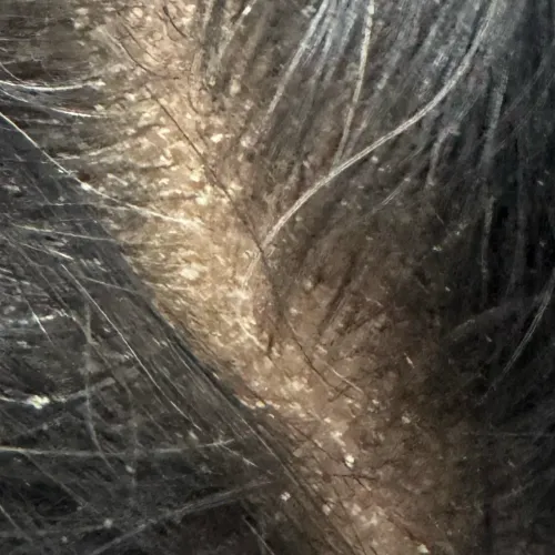 trichy dermatologist for hair