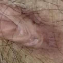keloid removal dermatologist t