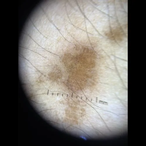 Laser Hair Treatment options d