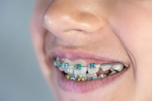 toothcolored brackets make