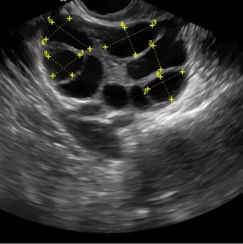 Follicular Monitoring TVS Ultr