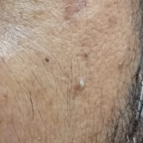 milia removal in trichy