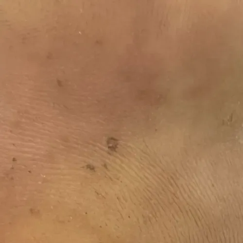 keloid removal dermatologist t