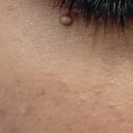 milia treatment in trichy