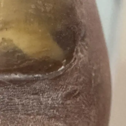 keloid removal dermatologist t