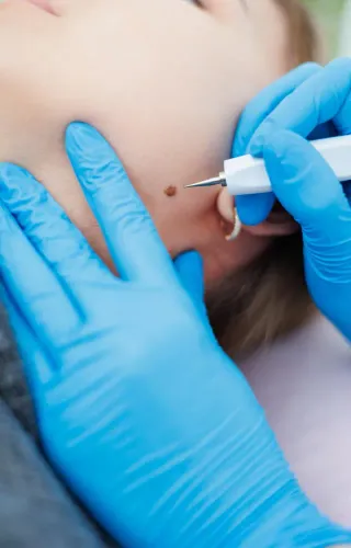 Skin tags are small, soft grow
