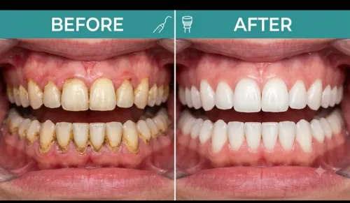 Teeth Scaling and Polishing Be