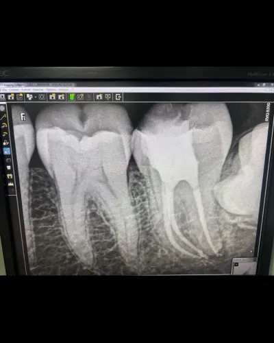 #Best root canal treatment Sin