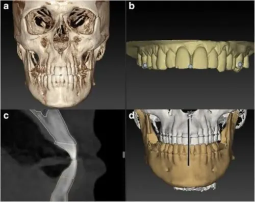 CBCT Scan A CBCT Scan (Cone Be