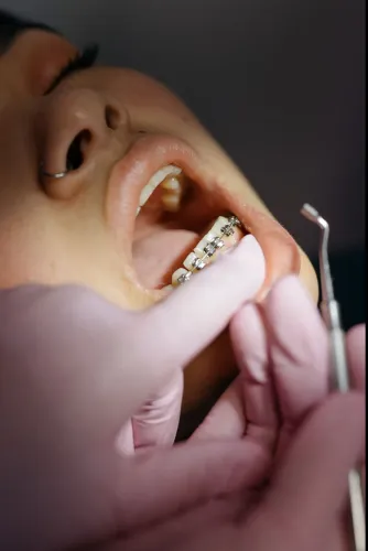 Lingual Braces & Hidden Braces