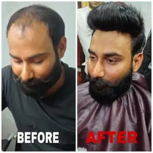 human hair patch service rohin