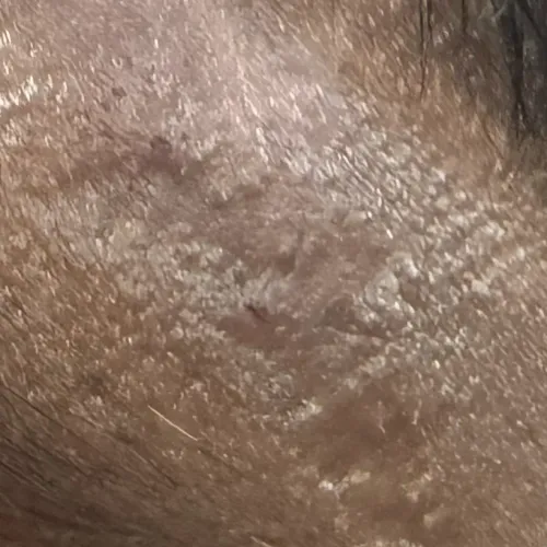 scar treatment in trichy