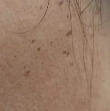 Dr.s.Valarmathi, a skin tag re