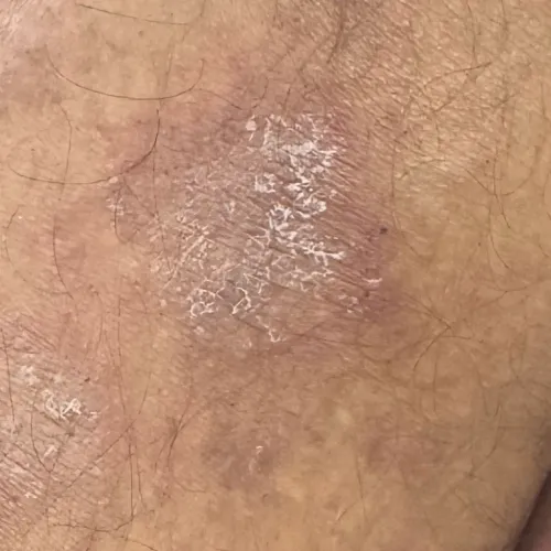 Dr.s.Valarmathi, a dermatologi