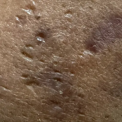 fractional co2 laser for acne