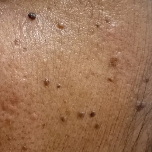 milia removal in trichy