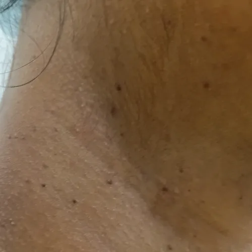laser hair reduction trichy
