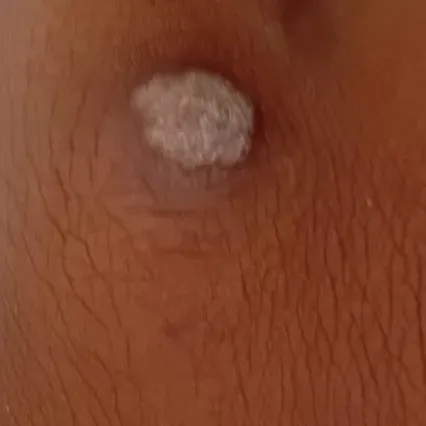 milia removal in trichy