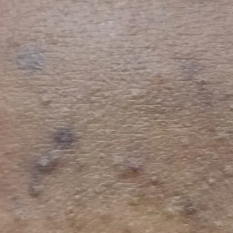 fractional co2 laser treatment