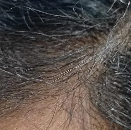 Dr.s.Valarmathi, the best derm