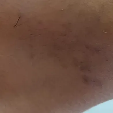 Dr.s.Valarmathi, a laser hair 