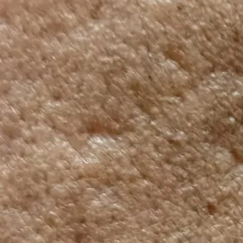 fractional co2 laser for acne 