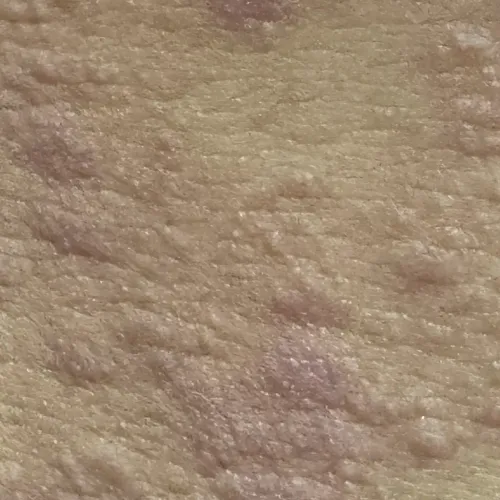 itching treatment in trichy