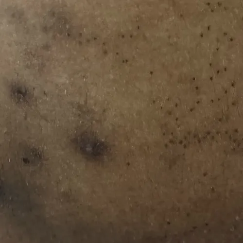 fungal infection dermatology t