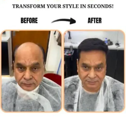 hair patch in Rohini budget-fr