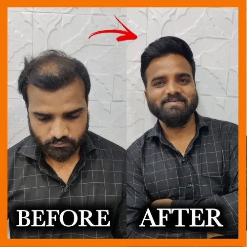 Hair patch in Rohini Breathabi