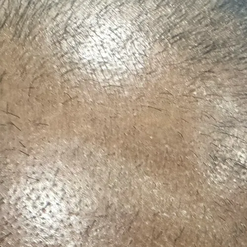 trichy dermatologist for hair